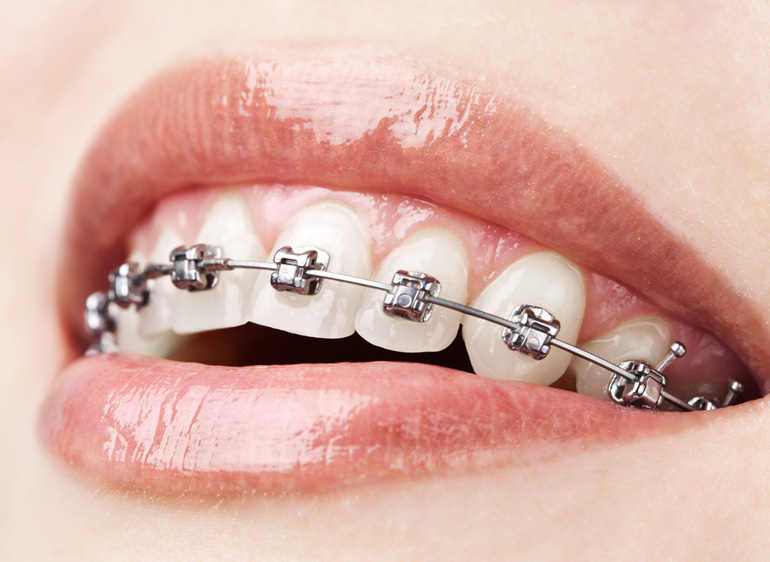 Santa Monica Othodontist